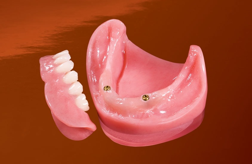 Overdenture with two locator implant attachments