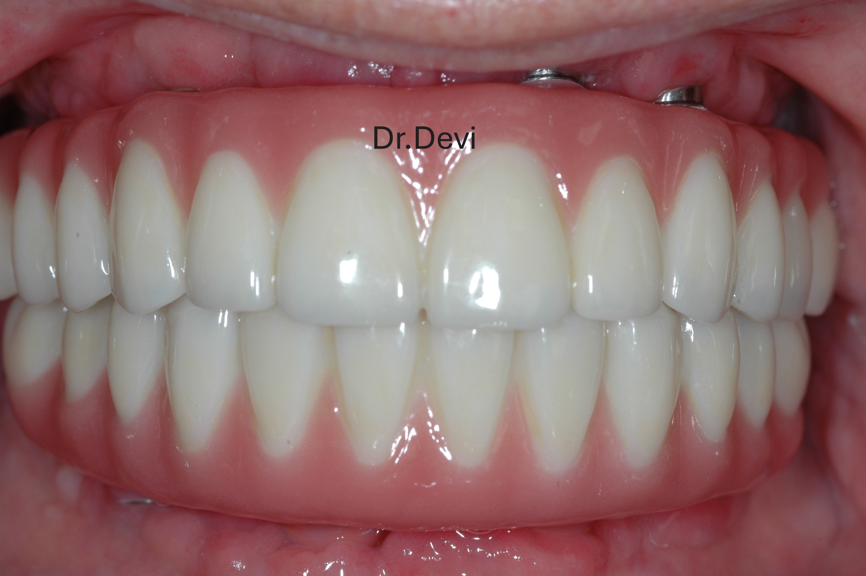 Implant failure requiring revision