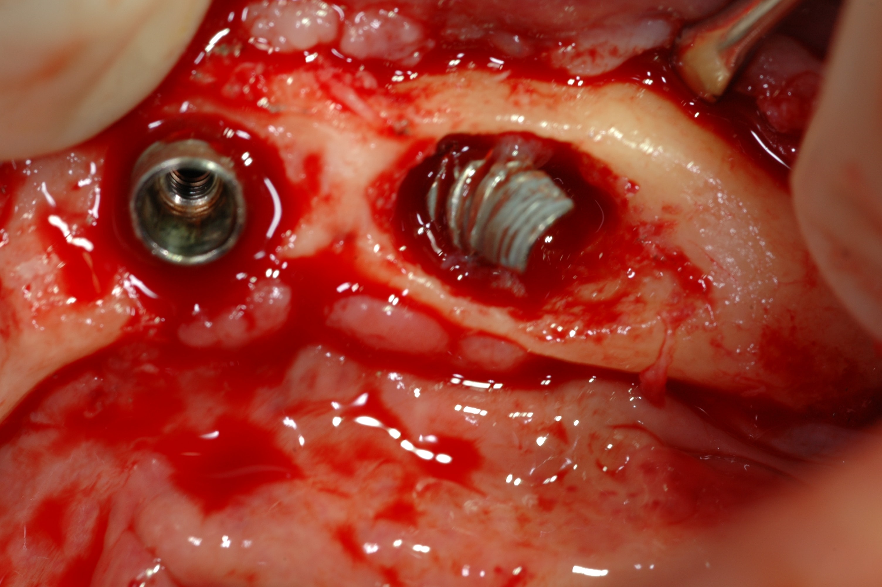 Fractured dental implants inside the jawbone