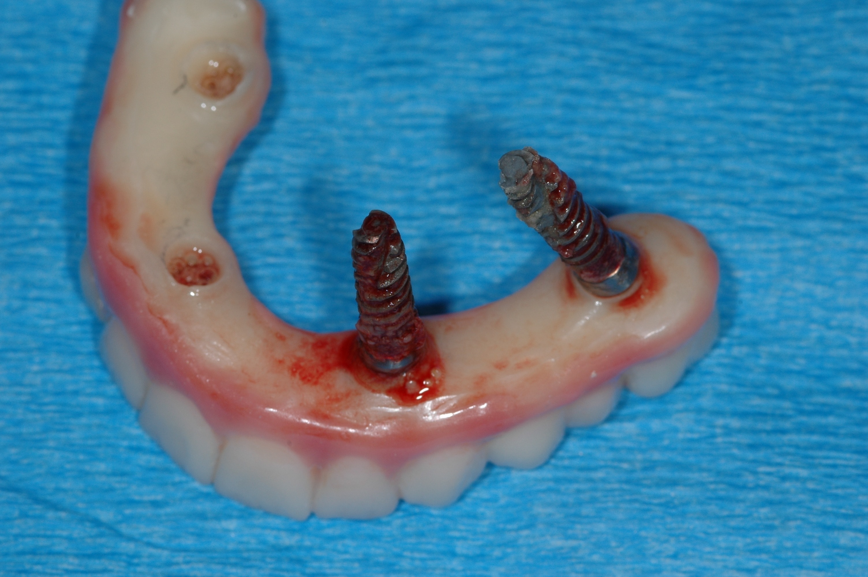 Exposed dental implants from bone loss
