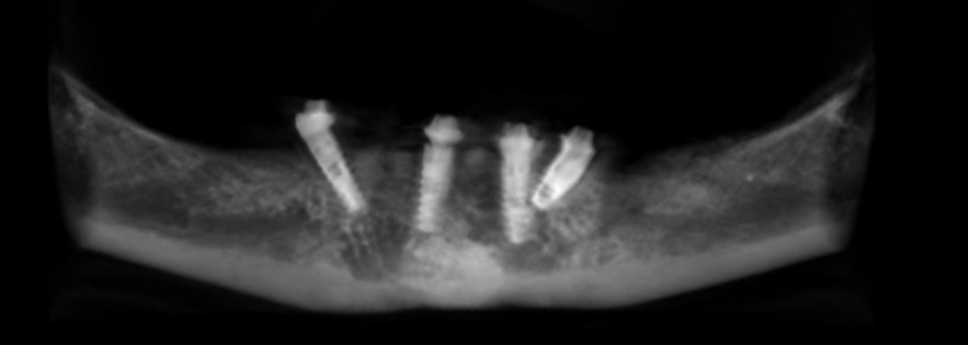 Panoramic X-ray showing implants placed at poor angles — example of inadequate treatment planning