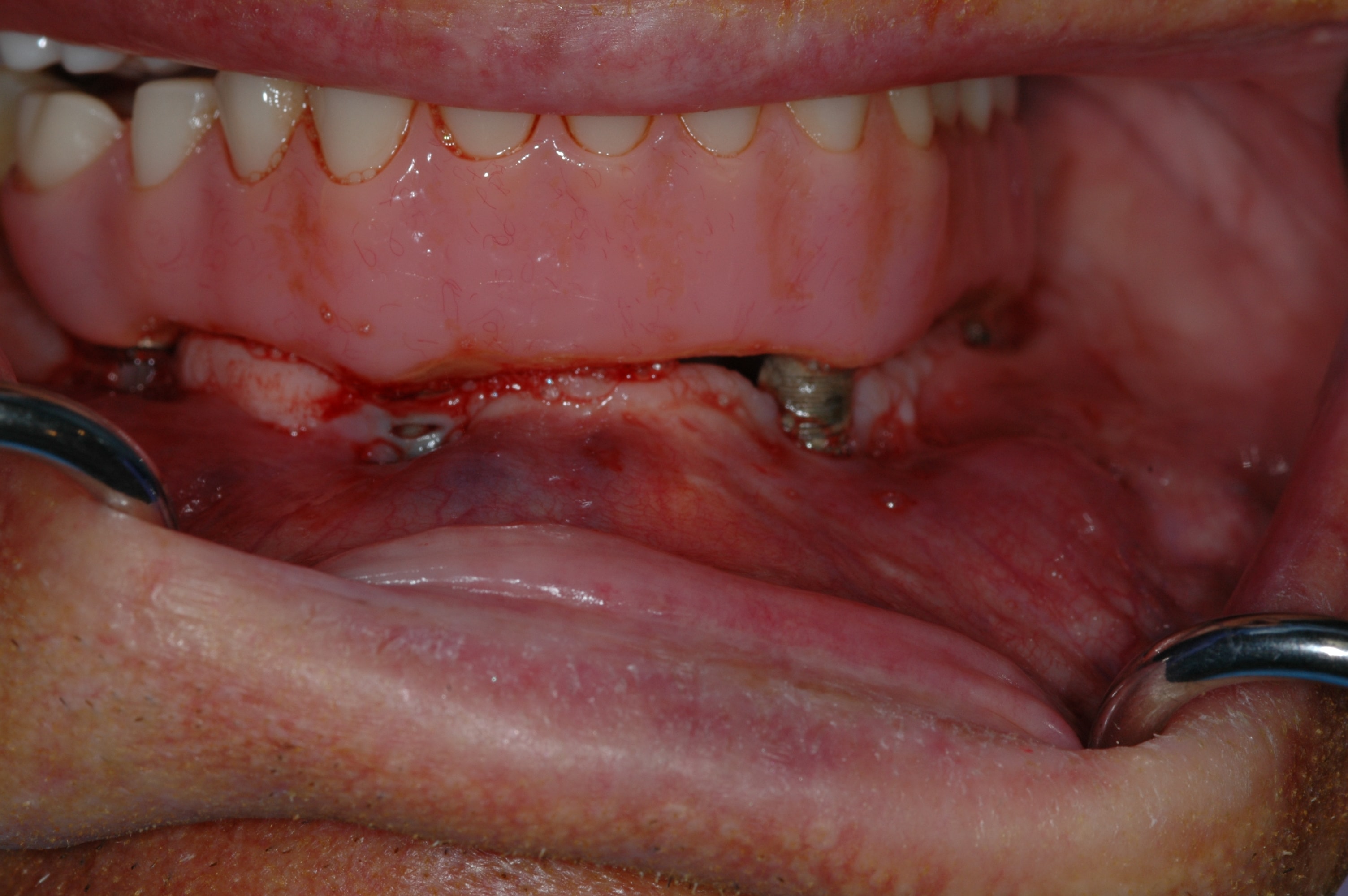 Implant locator attachment failure
