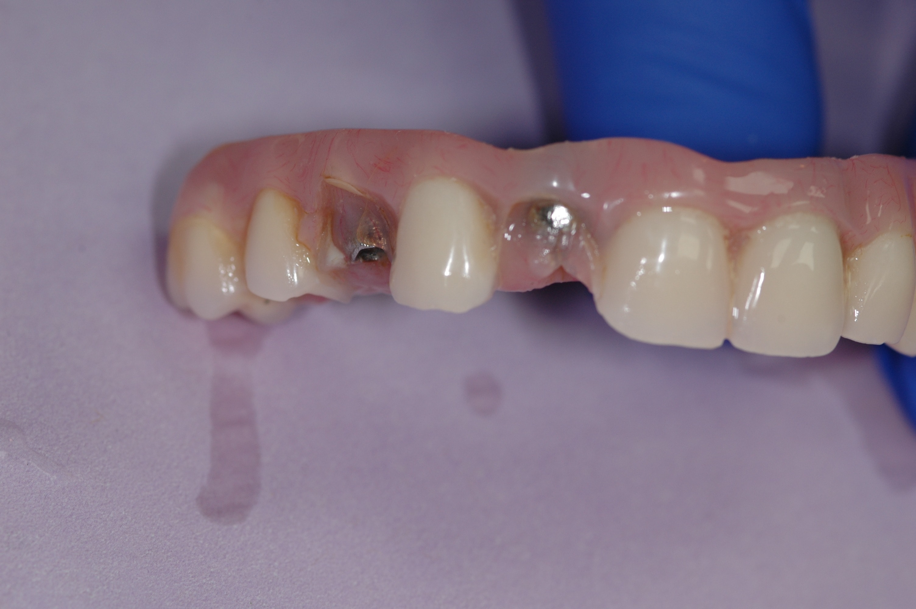 All-on-4 prosthetic failure example