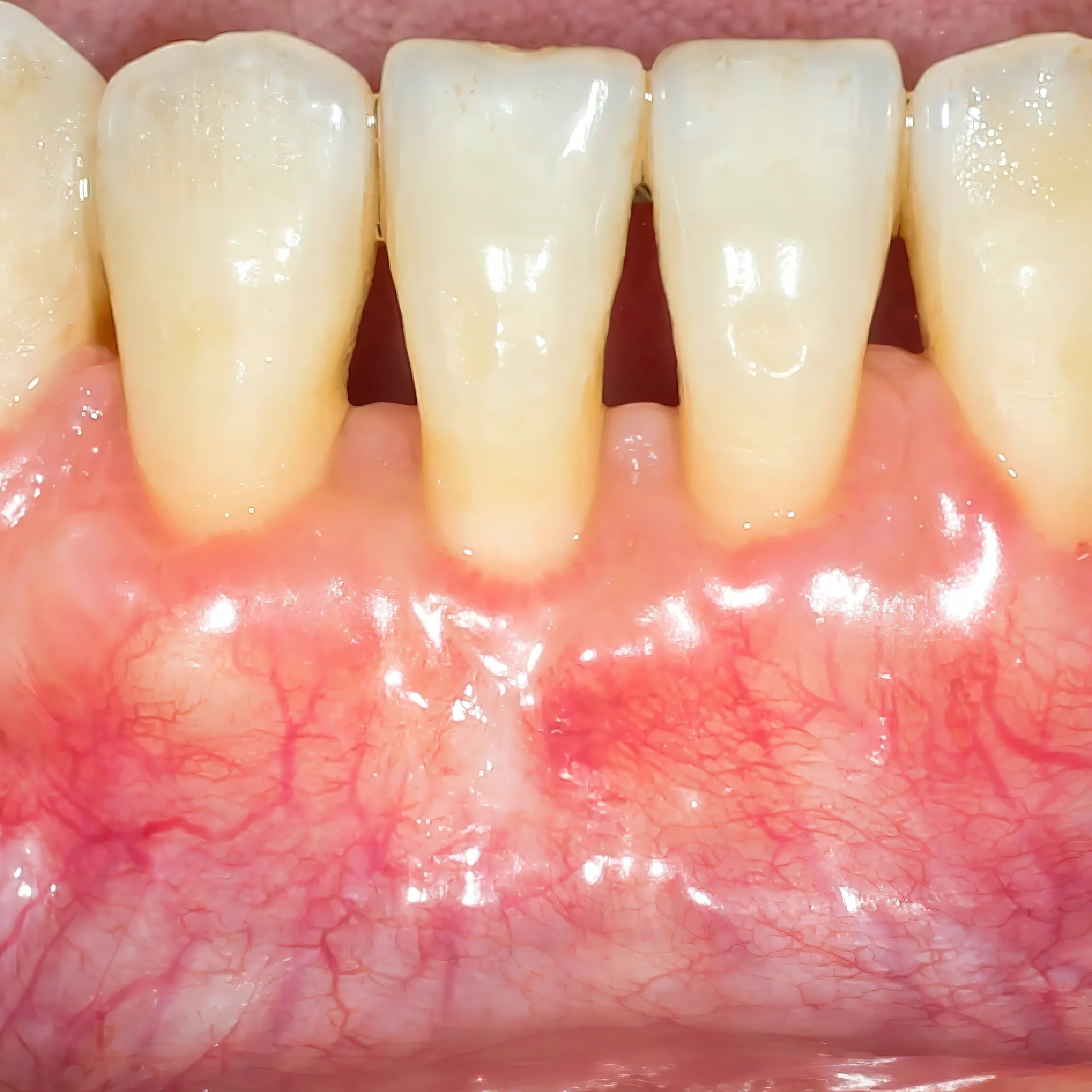 Gum Treatment