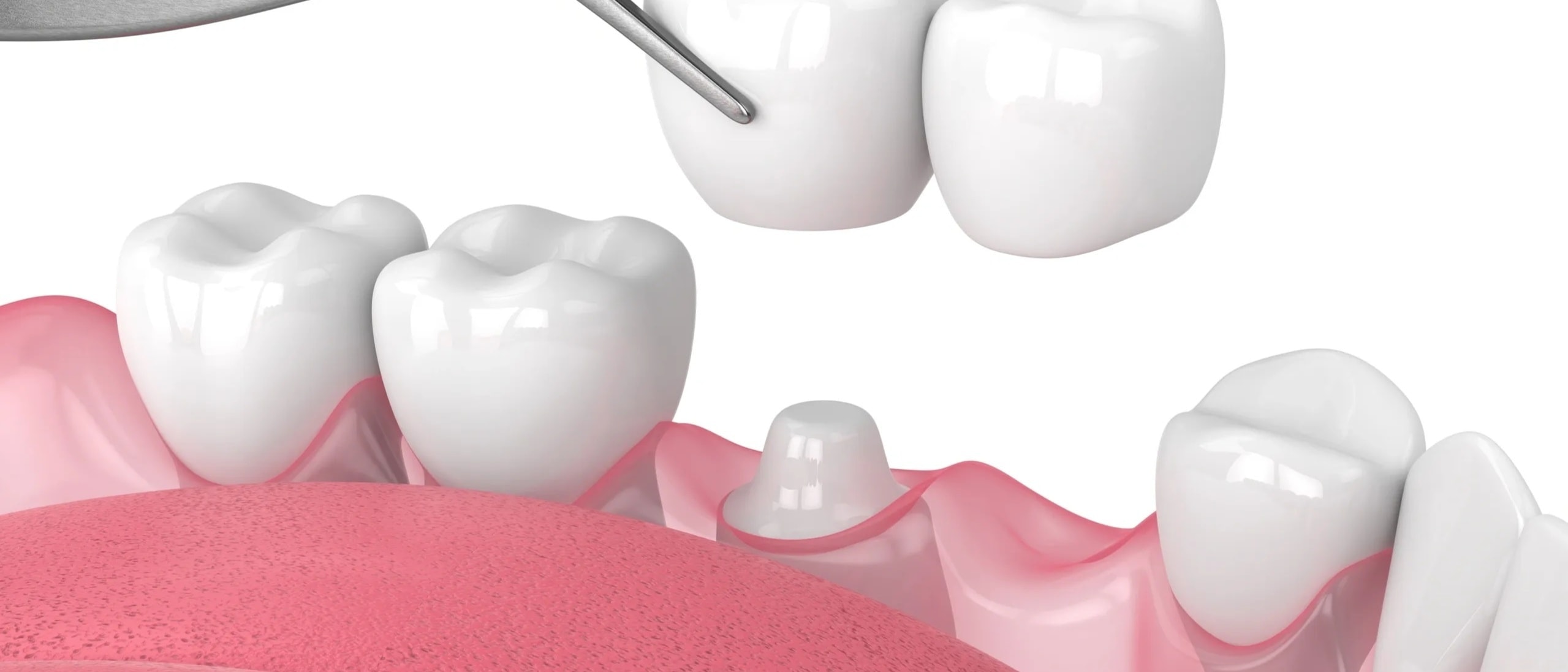 Dental Restorations