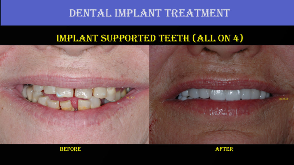 Dental Treatment Implant Case 1