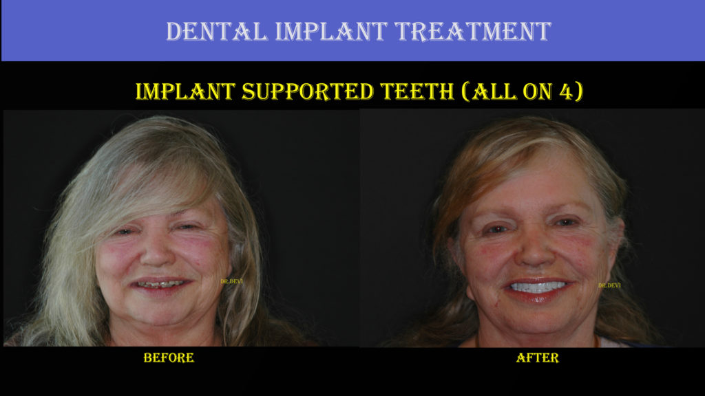 Dental Treatment Implant Case 2