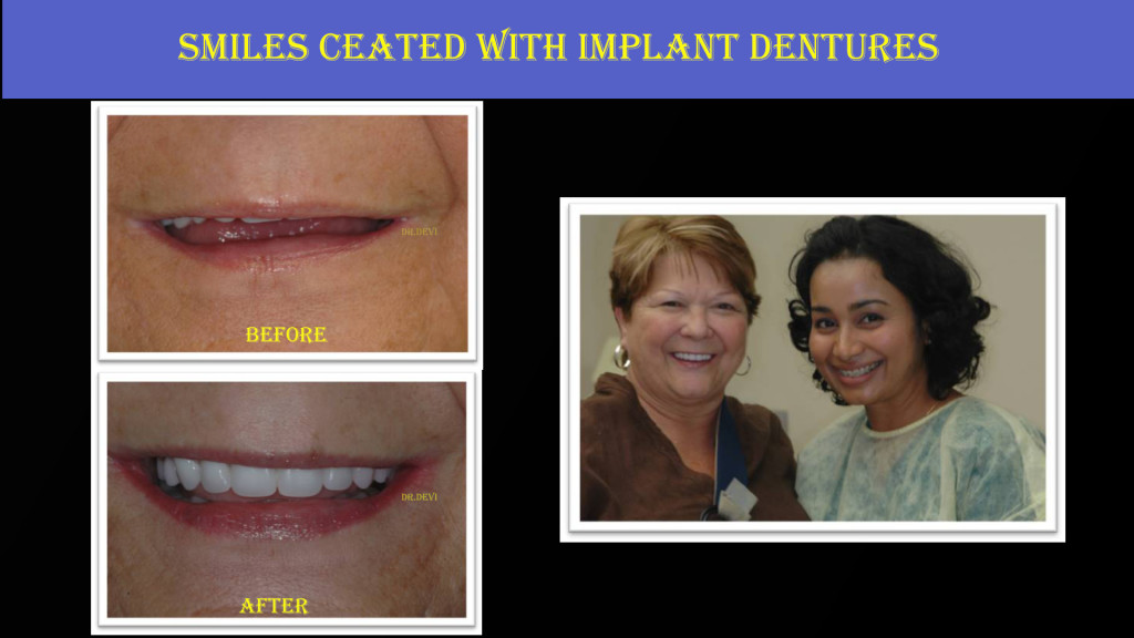 Smile Created with Implant Dentures By Dr. Devi