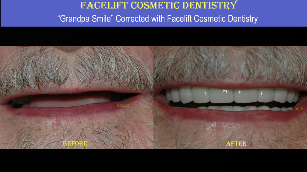 Facelift Cosmetic Dentistry
