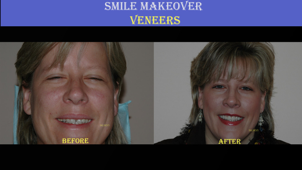 Smile Before and After Dental Veneer