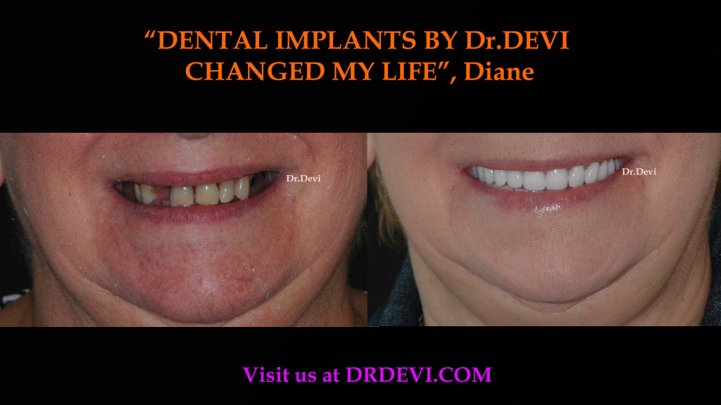 Dental Implants by Dr. Devi