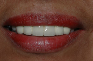 Results after cosmetic dentistry - Cave Creek Family Dentistry