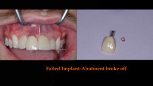 Failed Implant - Abutment Broke Off